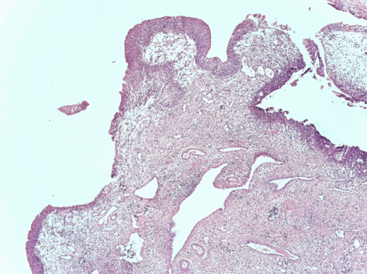 Патоморфологическое исследование пациента М. Морфологическая картина полипоидного цистита. Окраска гематоксилин-эозином, х5