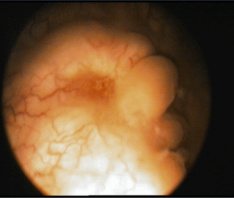 Цистоскопическое обследование пациентки К. Цистоскопическая картина солидного образования, вдающегося в полость мочевого пузыря