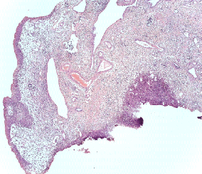 Патоморфологическое исследование пациентка О. Морфологическая картина полипоидного цистита с наличием гиперплазированного уротелия, признаков острого и хронического воспаления, реактивной уротелиальной атипии с множественными митозами, отеком собственной пластинки слизистой с фиброзом и полнокровными сосудами и полипоидными выпячиваниями. Окраска гематоксилин-эозином, х5