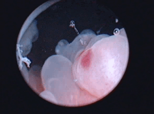 Цистоскопическое обследование пациентки О. Цистоскопическая картина солидного образования