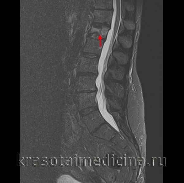 Перелом грудного отдела позвоночника
