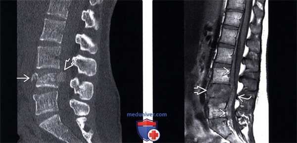 КТ, МРТ взрывного перелома грудного и поясничного позвонков