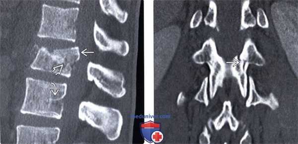 КТ взрывного перелома грудного и поясничного позвонков