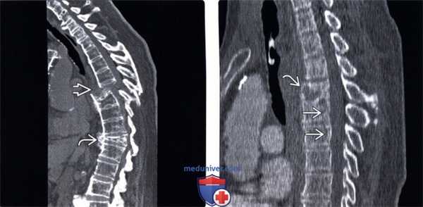 КТ, МРТ при гиперэкстензионном повреждении грудного и поясничного отдела позвоночника