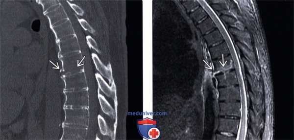 КТ, МРТ при гиперэкстензионном повреждении грудного и поясничного отдела позвоночника