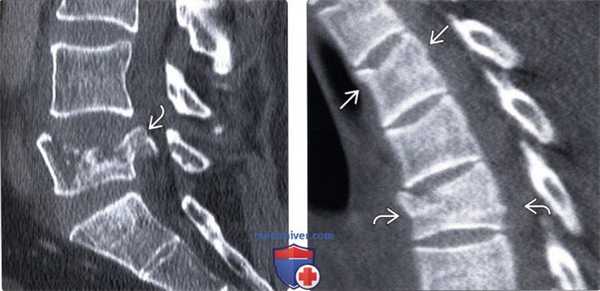 КТ взрывного перелома грудного и поясничного позвонков