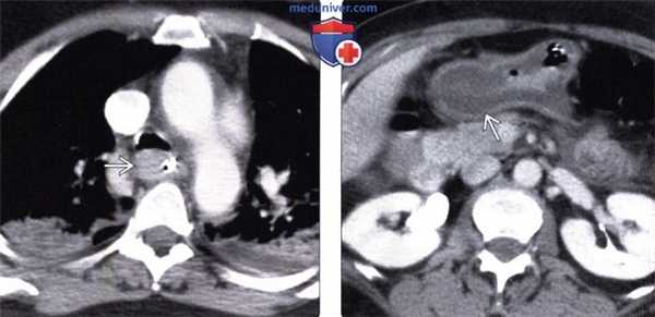 Лучевая диагностика химического ожога пищевода (эзофагита от химического воздействия)