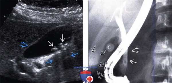 УЗИ при холедохолитиазе (камне в холедохе)