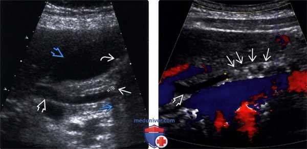 УЗИ при холедохолитиазе (камне в холедохе)