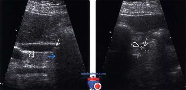 УЗИ при холедохолитиазе (камне в холедохе)