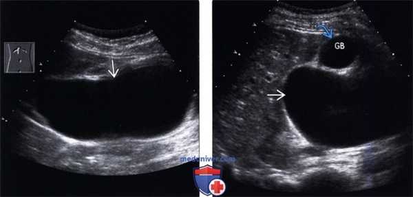 УЗИ, КТ, МРТ при кисте холедоха