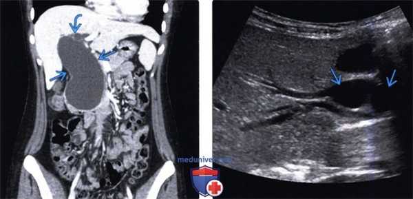 УЗИ, КТ, МРТ при кисте холедоха