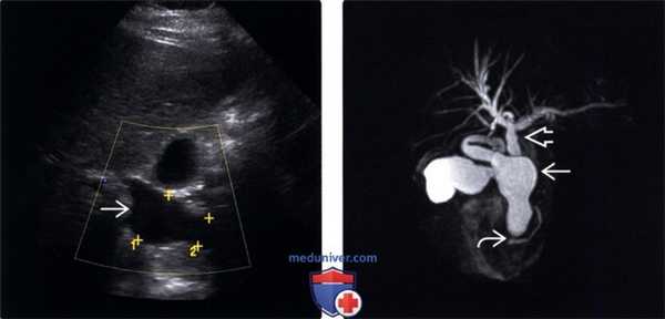УЗИ, КТ, МРТ при кисте холедоха