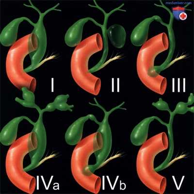 УЗИ, КТ, МРТ при кисте холедоха