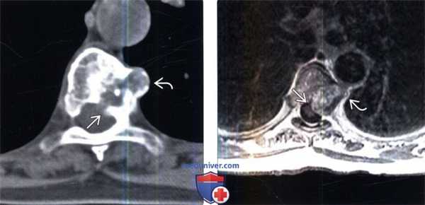 КТ, МРТ хондросаркомы позвоночника