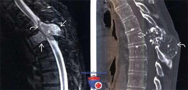 КТ, МРТ хондросаркомы позвоночника