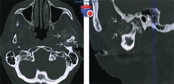 КТ, МРТ при хондросаркоме жевательного пространства