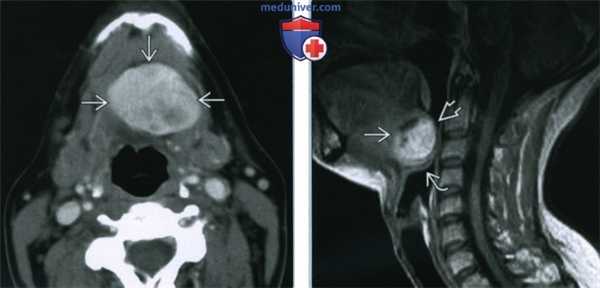 Язычная щитовидная железа - лучевая диагностика