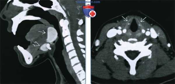 Язычная щитовидная железа - лучевая диагностика