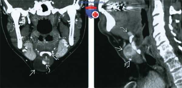 Рак щитоязычного протока - лучевая диагностика