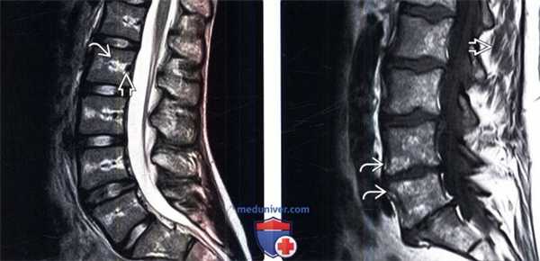 МРТ при жировой перестройке костного мозга позвоночника