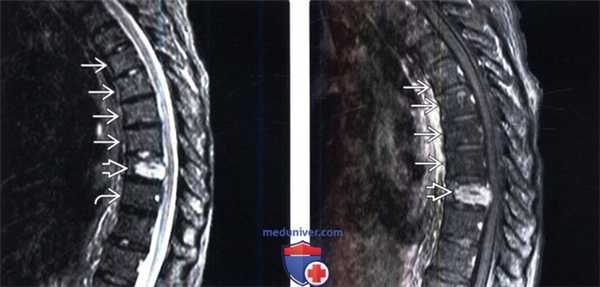 МРТ при постлучевых изменениях костного мозга