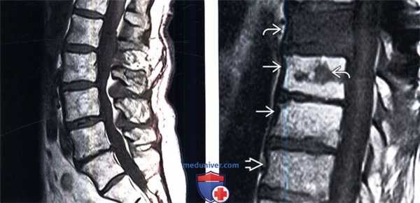 МРТ при жировой перестройке костного мозга позвоночника