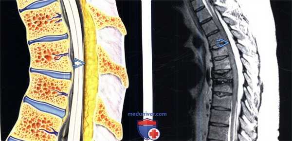 МРТ при эпидуральном липоматозе