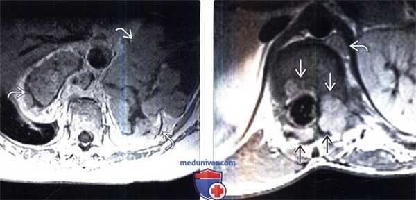 МРТ при злокачественой опухоли оболочки периферического нерва (ЗООПН)