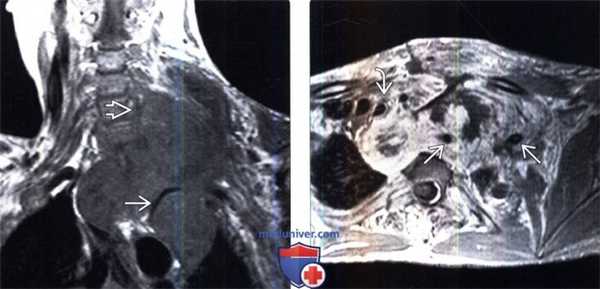 МРТ при злокачественой опухоли оболочки периферического нерва (ЗООПН)
