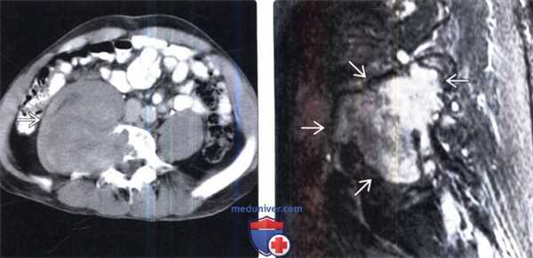 МРТ при опухоли оболочки периферического нерва