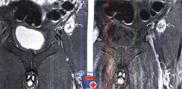 МРТ при опухоли оболочки периферического нерва