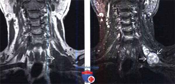 МРТ при опухоли оболочки периферического нерва