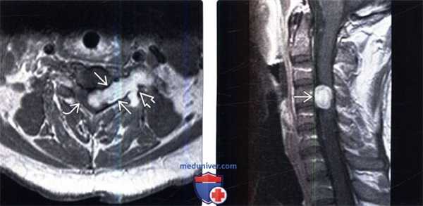 МРТ при нейрофиброме позвоночника