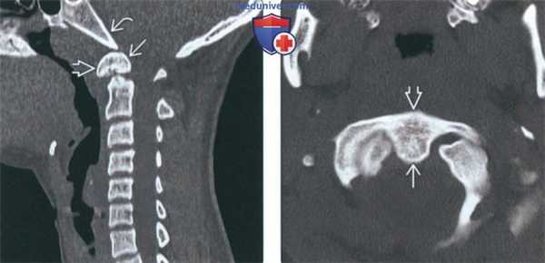 КТ, МРТ при зубовидной кости