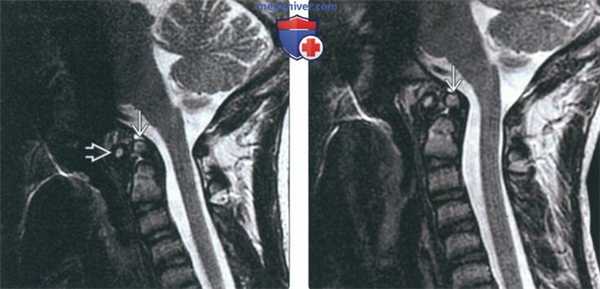 КТ, МРТ при зубовидной кости