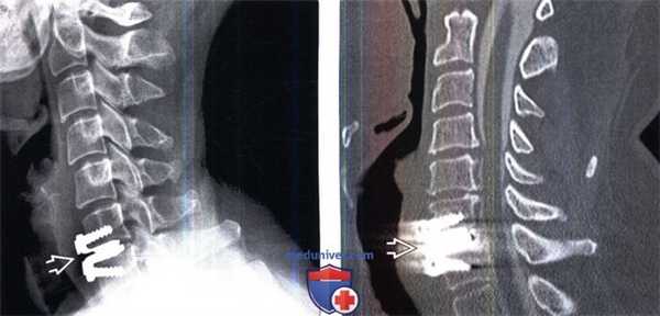 Рентгенограмма, МРТ искусственного шейного межпозвонкового диска