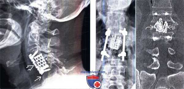 Рентгенограмма, КТ при Кейджах позвоночника