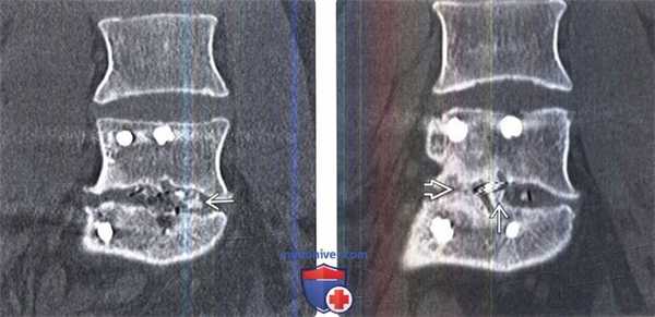 Рентгенограмма, КТ межтеловых спейсеров позвоночника