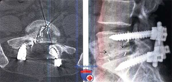 Рентгенограмма, КТ межтеловых спейсеров позвоночника