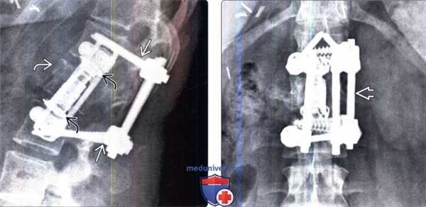 Рентгенограмма, КТ при Кейджах позвоночника