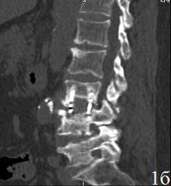 Рис. 1. Пациент В. Титановая блок-решетка без наполнения через 1 месяц (А) и через 12 месяцев (Б) после операции. Нарастание «продавливания» имплантатом кости с увеличением перифокального склероза и резорбции костной ткани