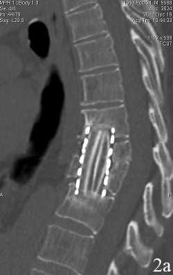 Рис. 2. Пациент У. Титановая блок-решетка с аутокостью через 6 месяцев (А) и через 12 месяцев (Б.) после операции. Отсутствие зоны резорбции вокруг имплантата без выраженного склероза, полная ассимиляция трансплантата с ложем