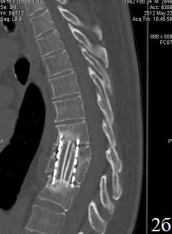 Рис. 2. Пациент У. Титановая блок-решетка с аутокостью через 6 месяцев (А) и через 12 месяцев (Б.) после операции. Отсутствие зоны резорбции вокруг имплантата без выраженного склероза, полная ассимиляция трансплантата с ложем