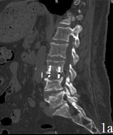 Рис. 1. Пациент В. Титановая блок-решетка без наполнения через 1 месяц (А) и через 12 месяцев (Б) после операции. Нарастание «продавливания» имплантатом кости с увеличением перифокального склероза и резорбции костной ткани