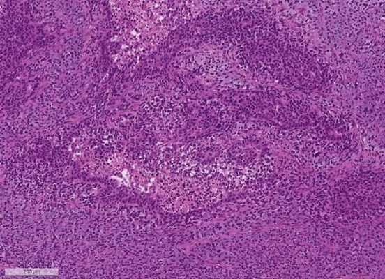 метастаз серозной карциномы яичника