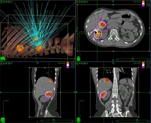 Наиболее наглядным визуальным примером того, как работает радиохирургия, является визуализация плана лечения на Кибер-ноже: зоны высокой дозы радиации (внутри оранжевого контура) сформированы из точек пересечения одиночных тонких пучков излучения (бирюзовые линии)