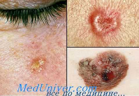 фотодинамическая терапия