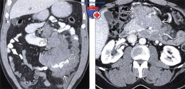 Лучевые изменения брюшной полости при ВИЧ/СПИД