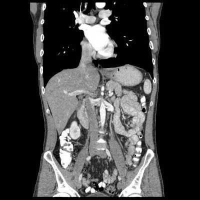 kt bryushnoj polosti